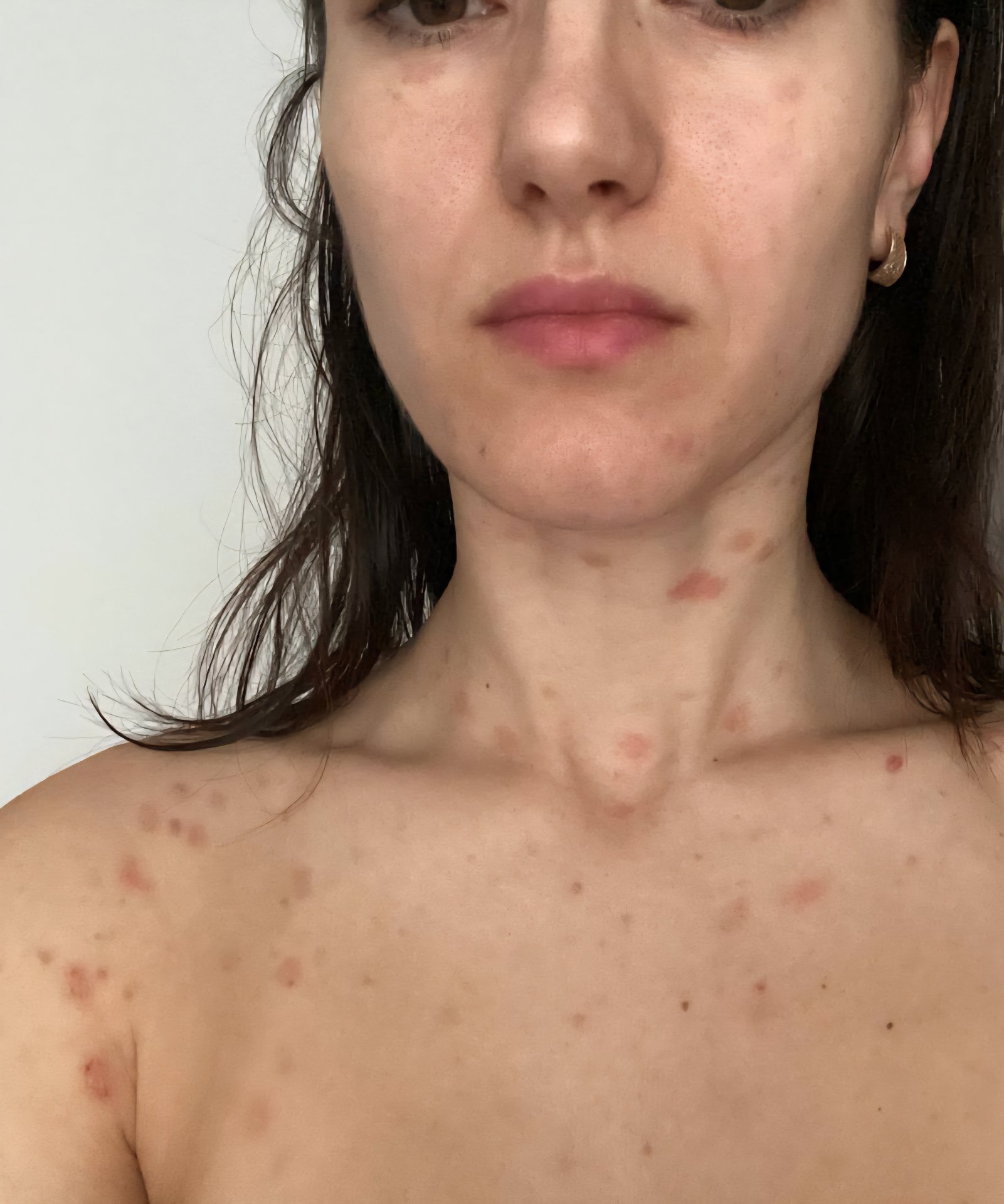 Victoria during her psoriasis journey — unretouched photograph of her skin